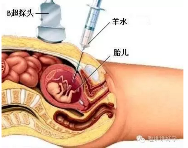 羊穿的最佳时间是孕17周