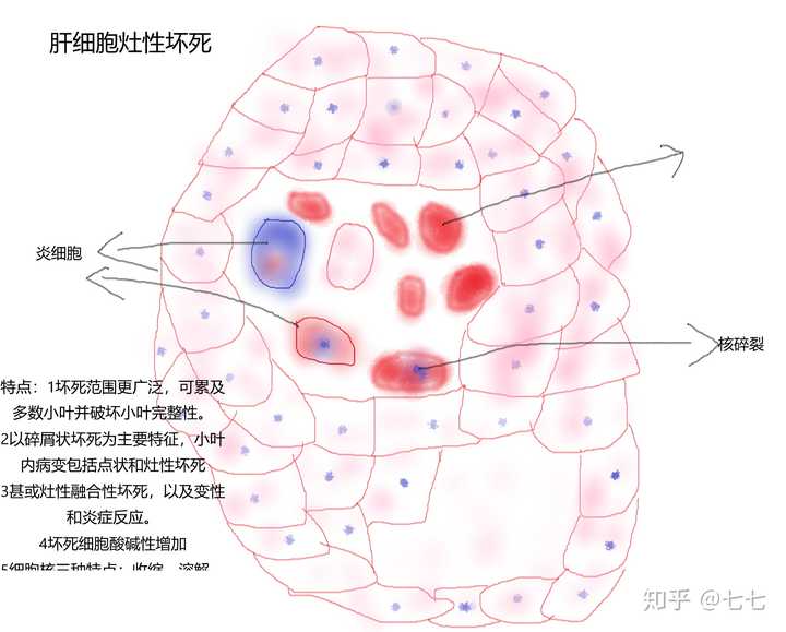 请问肝细胞水样变性和肝细胞灶性坏死的铅笔图怎么画?