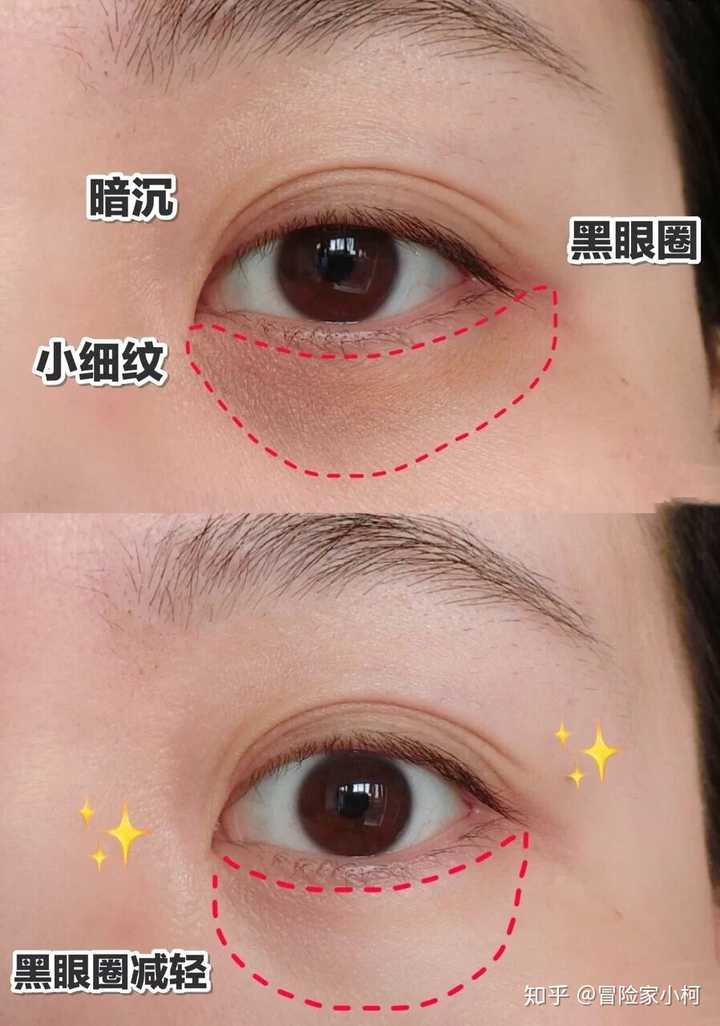 如何去除黑眼圈 知乎