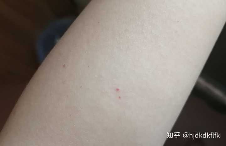 手臂上很多小红点是怎么回事 需要注意些什么 之前入职体检的时候所有检查项目都合格的 身体没有不适 知乎 手臂上很多小红点是怎么回事 需要注意些什么 之前入职体检的时候所有检查项目都合格的 身体没有不适 知乎