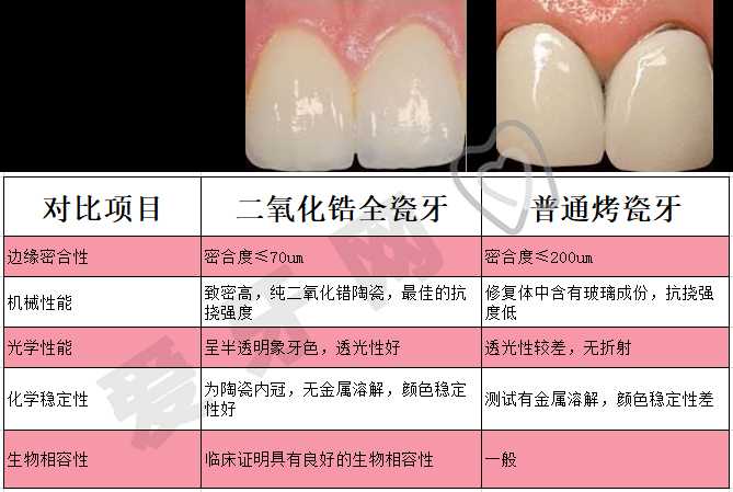 烤瓷牙全瓷牙種植牙有什麼區別哪個比較好