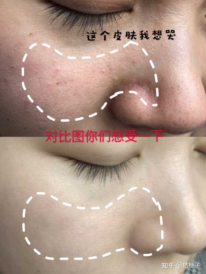 求救 23岁 毛孔粗大皮肤还有救嘛 知乎 求救 23岁 毛孔粗大皮肤还有救嘛 知乎
