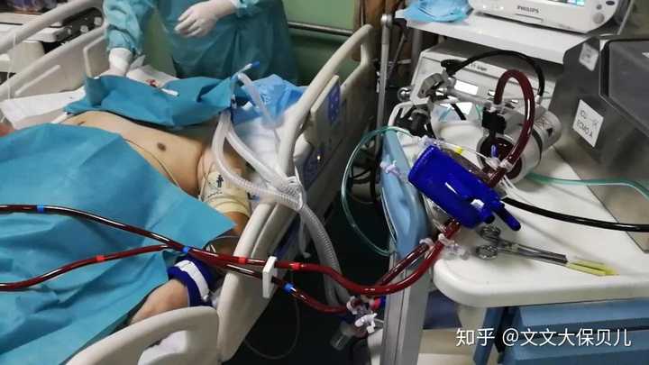 叶克膜 Ecmo 是一种什么技术 知乎