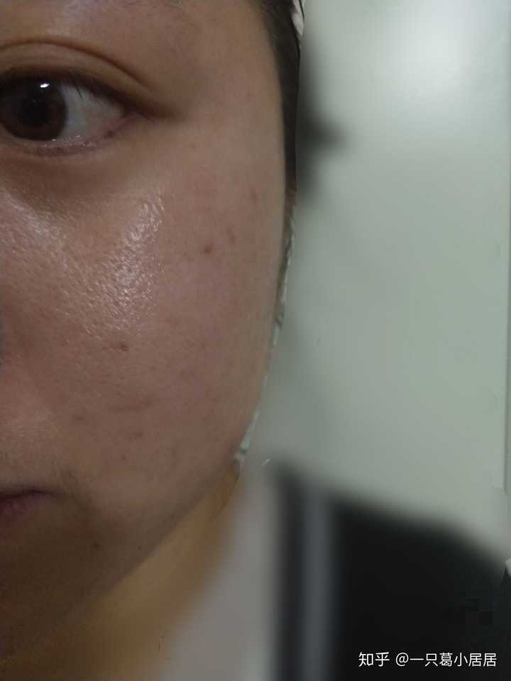 今天一照镜子吓一跳,脸颊泛红,毛孔粗大,请教各位救救孩子吧!
