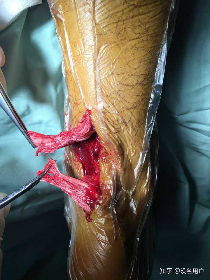 跟腱断裂之后,手术是如何接上的呢?