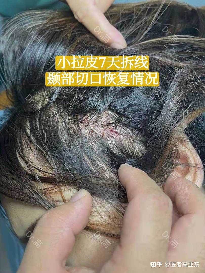 医者高亚东 的想法: 双平面小拉皮提升7天拆线,切口在耳屏上… - 知乎