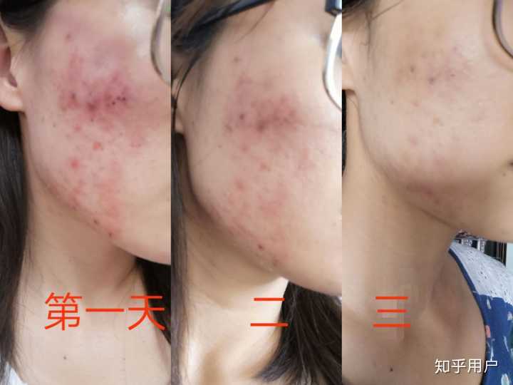 从去年10月到现在3月 针清了大概12次 也没有用什么产品 就芦荟胶