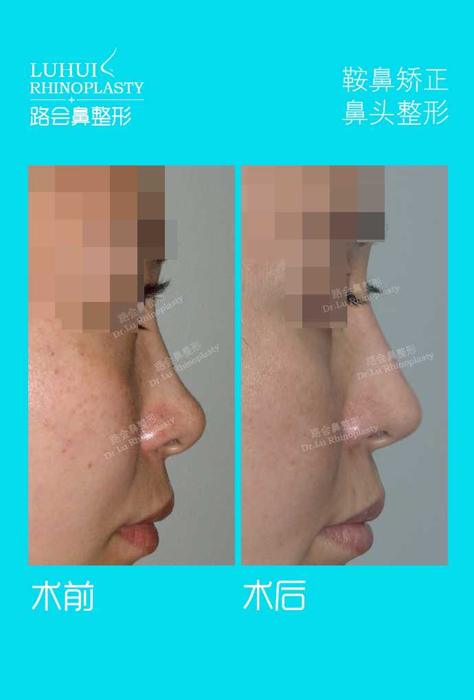 用膨体隆鼻好不好 有什么特点 知乎 用膨体隆鼻好不好 有什么特点 知乎