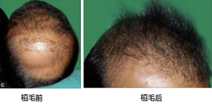 做植发的毛囊可以用阴毛毛囊 腋毛毛囊 鼻毛毛囊或者身上的汗毛毛囊吗 知乎 做植发的毛囊可以用阴毛毛囊 腋毛毛囊 鼻毛毛囊或者身上的汗毛毛囊吗 知乎