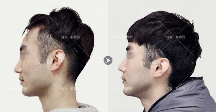 【真人案例】男士下颌角长曲线截骨瘦脸,… - 知乎