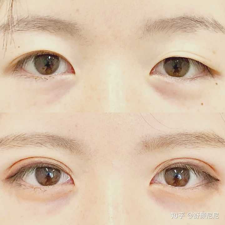 埋线双眼皮效果好吗,?