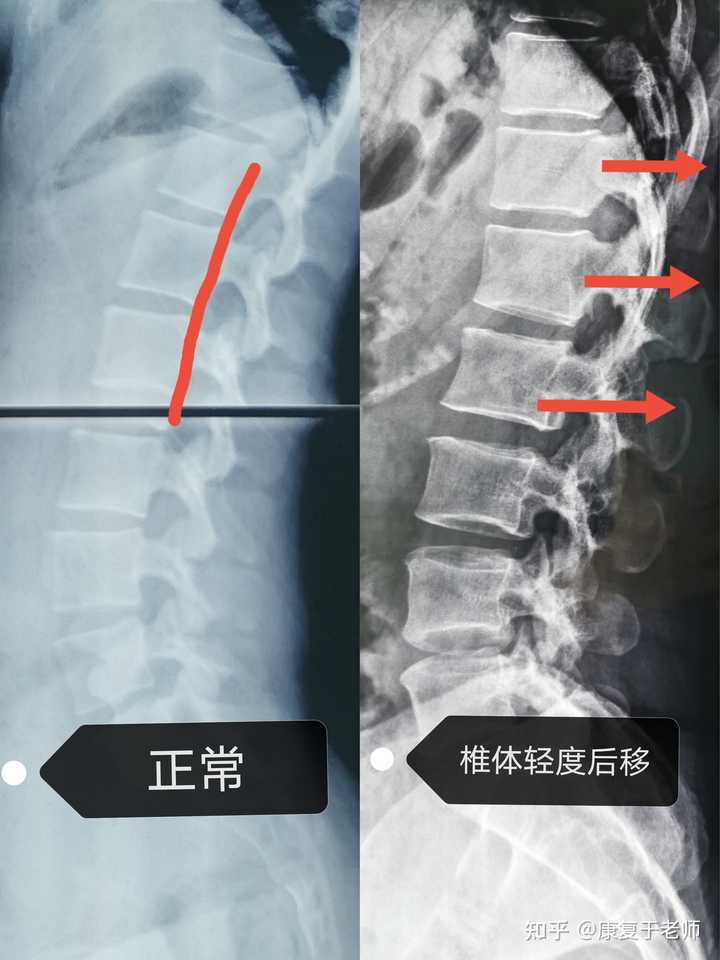 如何看待 漫画腰 挑战 值得模仿吗 知乎 如何看待 漫画腰 挑战 值得模仿吗 知乎