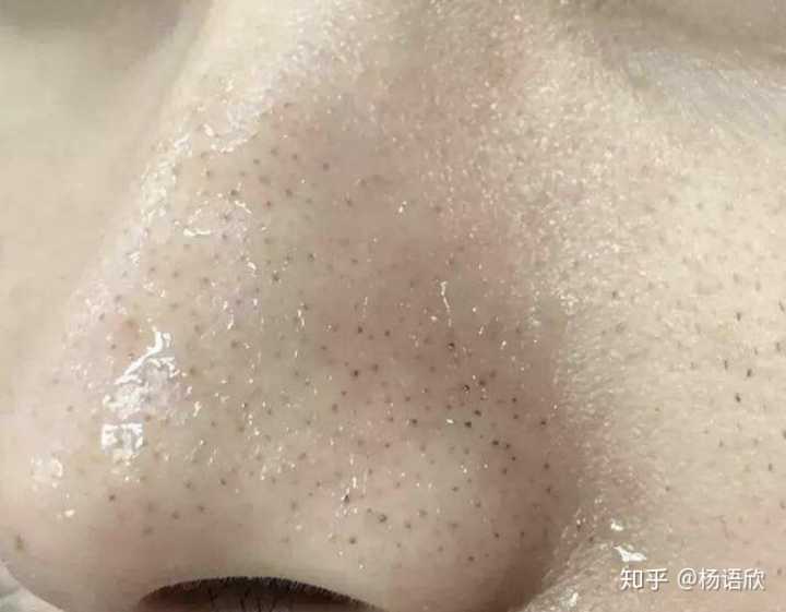 长的痘痘到底该不该挤 知乎 长的痘痘到底该不该挤 知乎