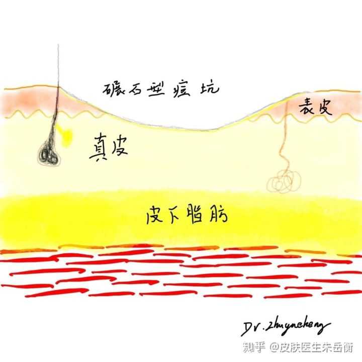 结节型痘痘要如何处置? - 知乎