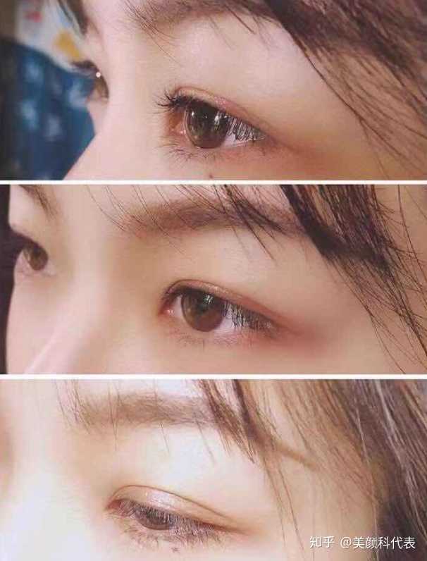 三点式双眼皮