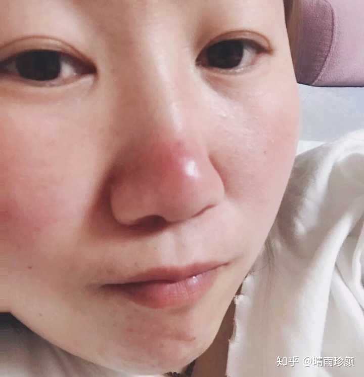 脸部只有鼻子上长痘是什么原因 有哪些解决方法 知乎 脸部只有鼻子上长痘是什么原因 有哪些解决方法 知乎