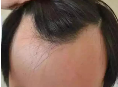 M型脱发该如何拯救 知乎 M型脱发该如何拯救 知乎