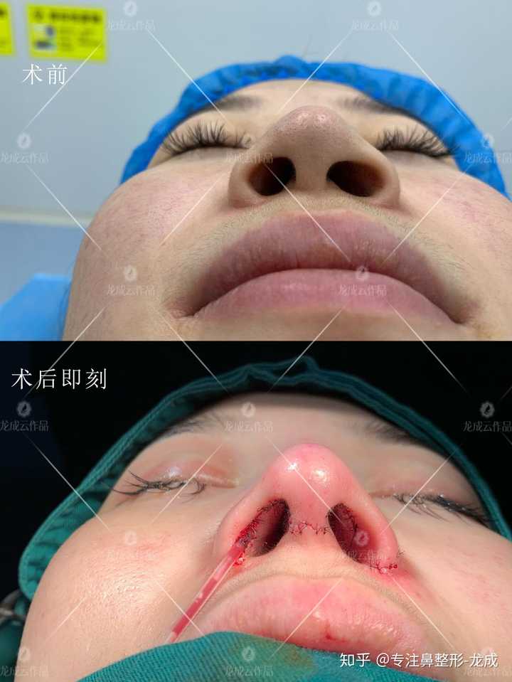 想问问大家,这种鼻子怎么拯救.(效果很自然的那种)?