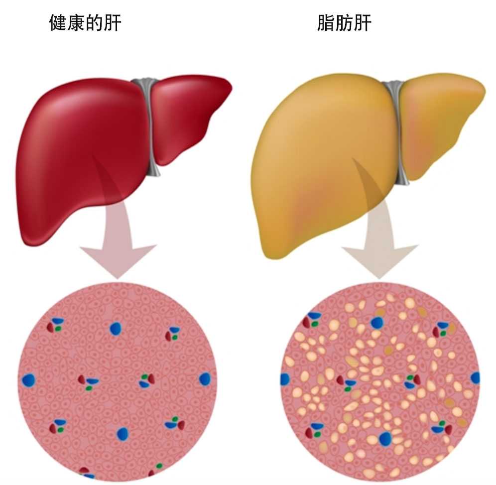 这里的"肝脂肪浸润",是一种轻度脂