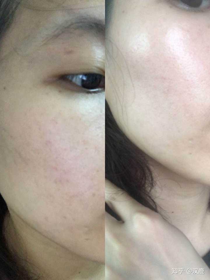 男生,95年的,皮肤粗糙毛孔大,还能养成一张干净的脸吗?