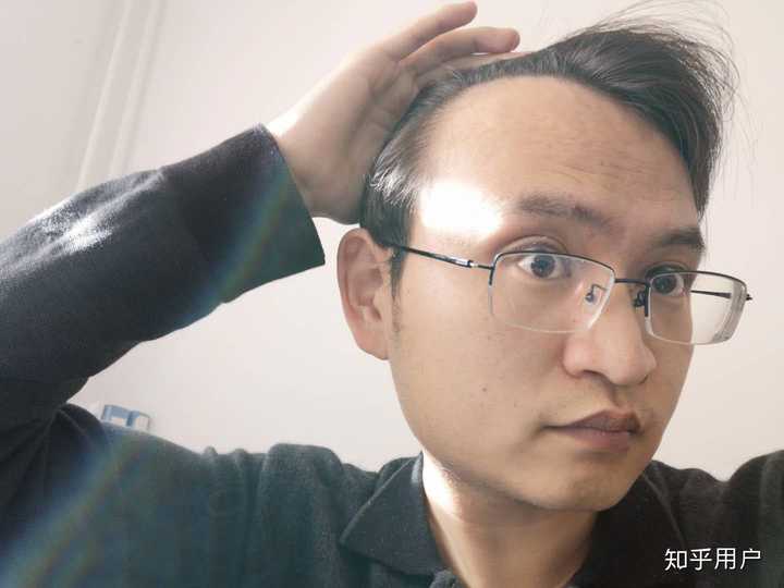 看起来很茂盛,其实额角很秃了