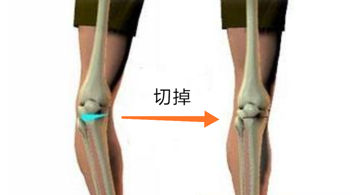 o型腿,x型腿,小腿肌肉外翻可以通过练习瑜伽得以矫正吗?