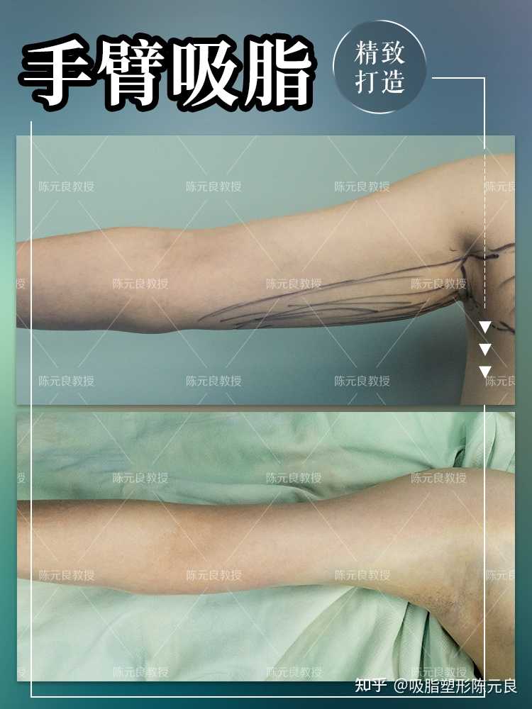 钻石精雕上臂吸脂会不会留疤