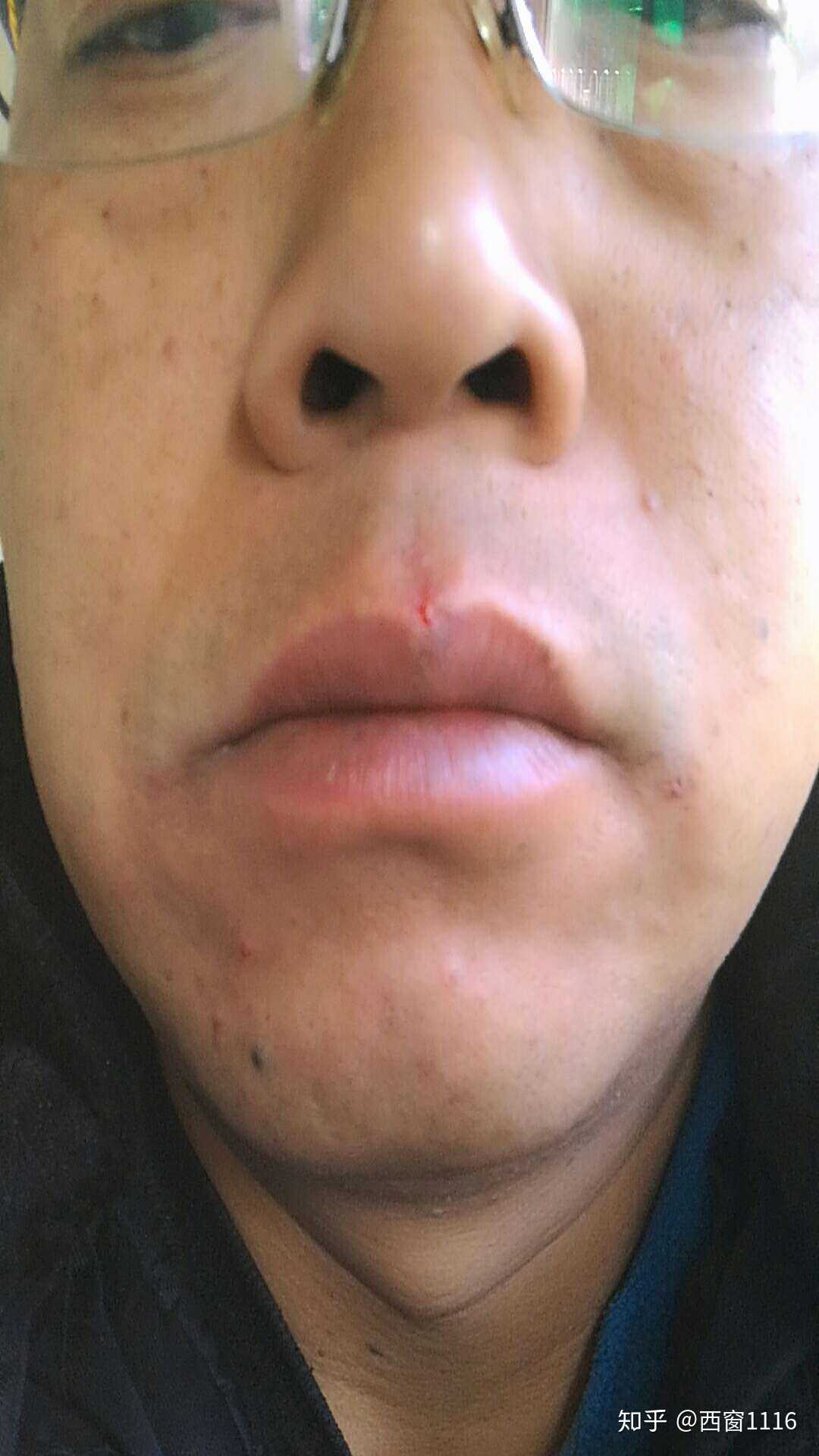 近段时间,脸上总出这种小毒疙瘩,不疼不痒的,烂后流黄水.