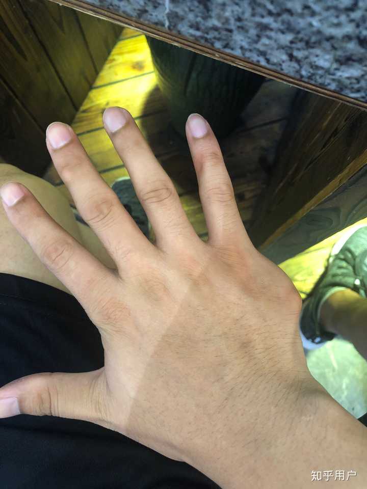 一只手有六个手指是种怎样的体验?