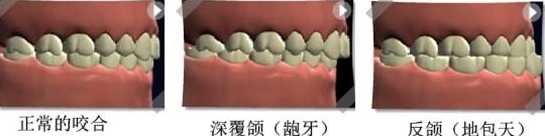 上下牙弓的"咬合线"平滑,连续,对称,呈椭圆形弧线,上下牙的尖窝关系
