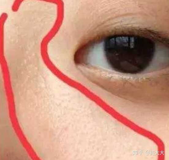眼睛鼻子周围的鸡皮肤(鼻子周围的皮肤像鸡皮图片)