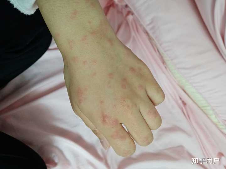 被臭虫咬是一种什么样的体验?
