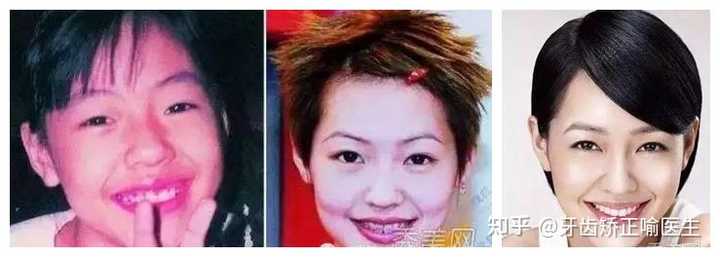 整牙成功是什么体验 知乎
