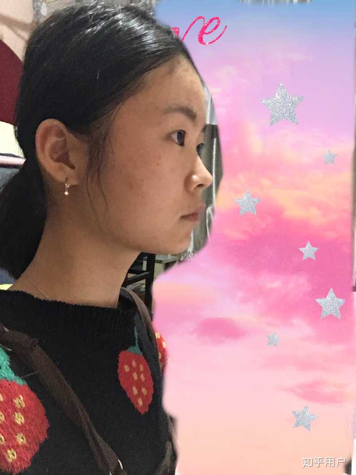 轻微嘴凸应该怎么办?