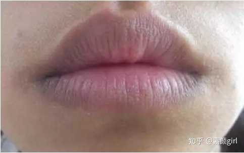 如何去除嘴角的黑色素 知乎 如何去除嘴角的黑色素 知乎