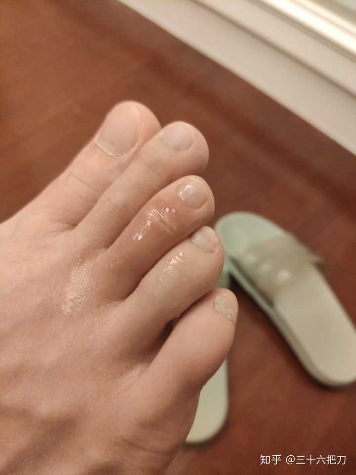 脚指头上有两道沟,偶尔会特别痒,有时候会肿,肿完会变得很硬一层皮