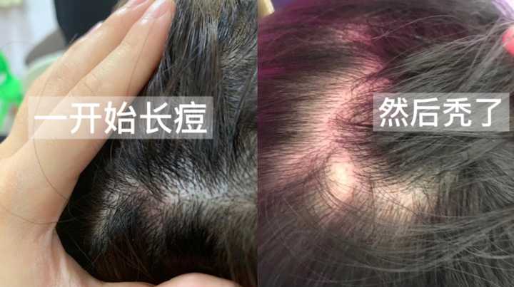 头部脂溢性皮炎，求推荐的洗发水，很多洗发水都过敏？ - 知乎