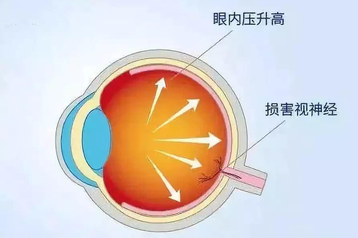 正常眼压值是多少？什么是眼压不正常？