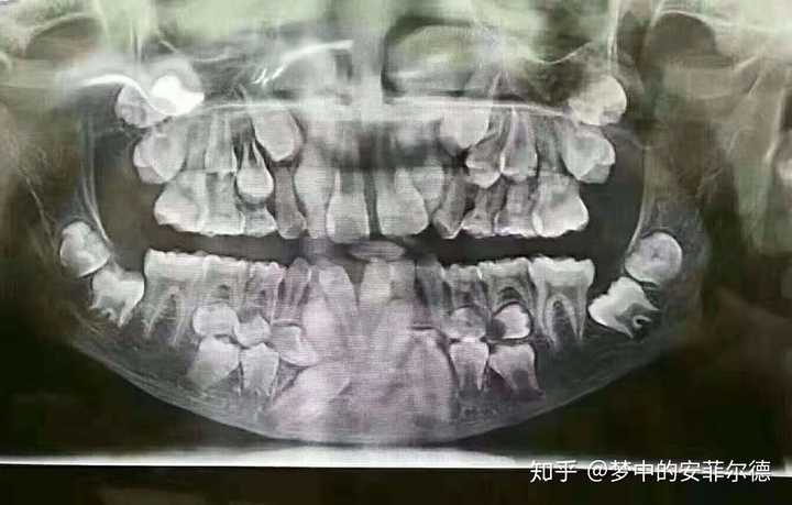 牙齿x光片龋齿图片