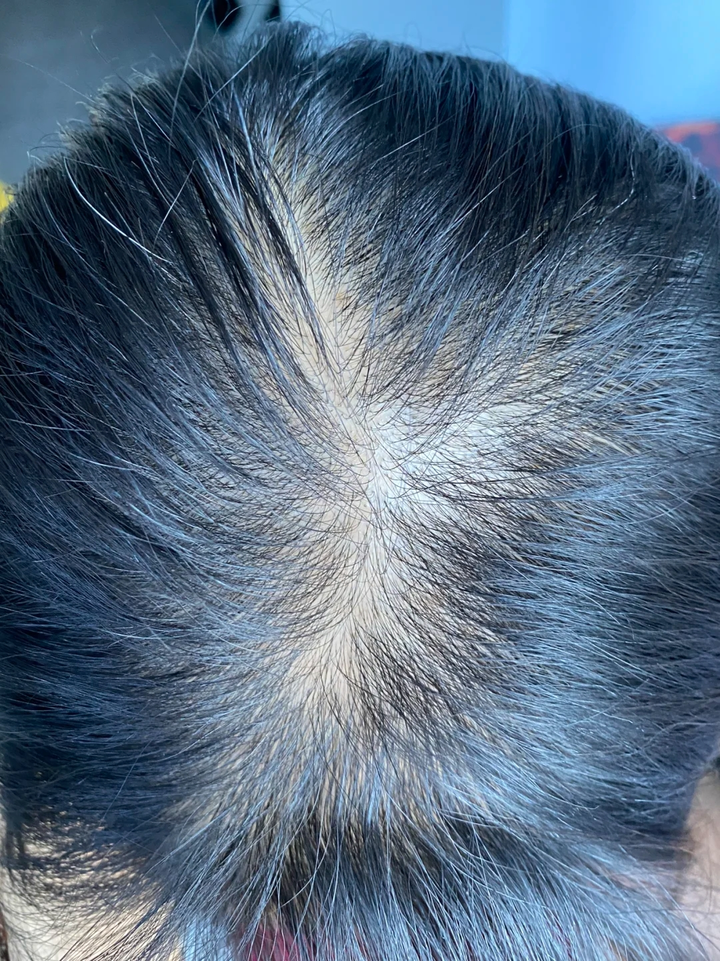 女生 发量少 头顶快秃了 有没有什么好的生发方法!!跪求!!? - 知乎
