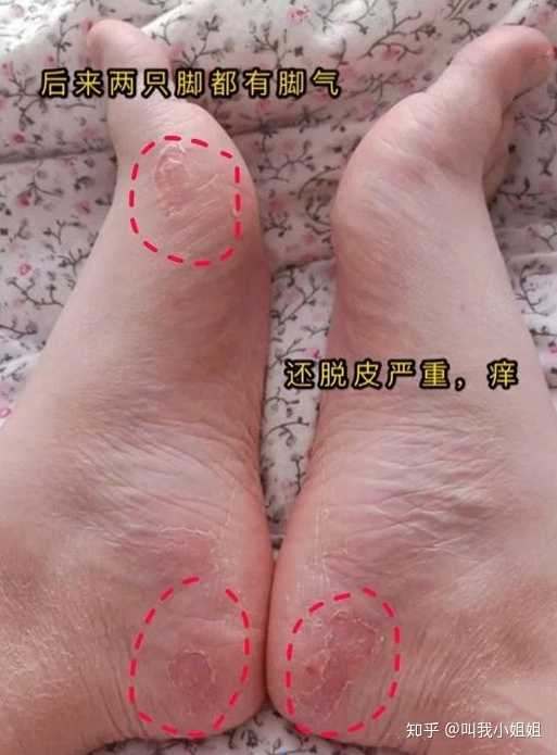 腳氣是怎樣形成的?