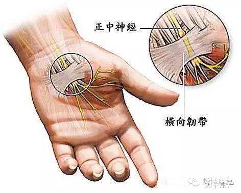 程序员怎么面对腱鞘炎? - 知乎