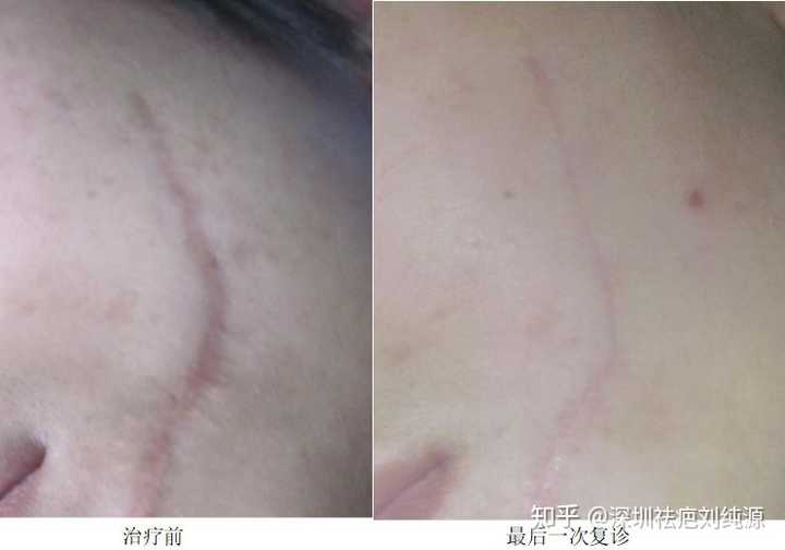 如何去掉旧疤痕?