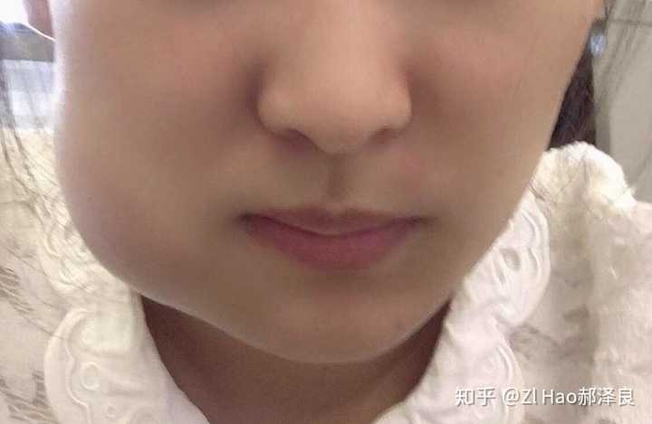 拔完智齿脸为什么会肿 知乎