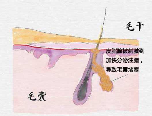 毛囊被堵住