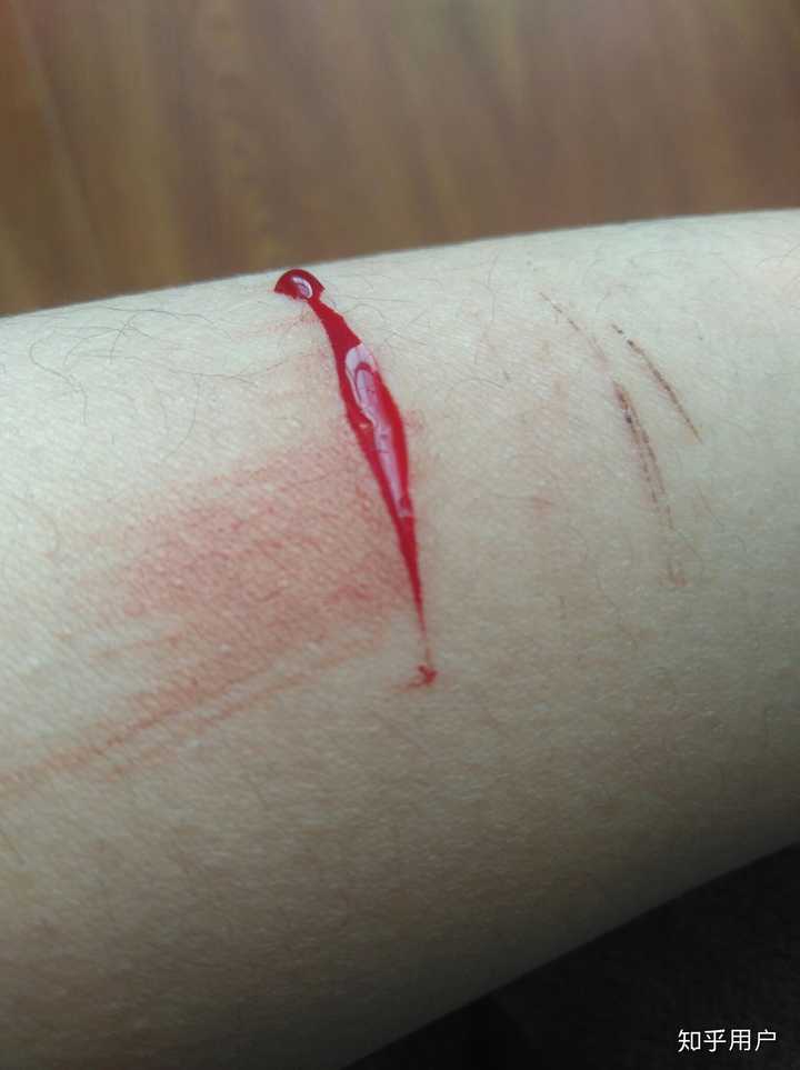 检查抑郁症的所有流程 我想去检查 可我真的很害怕 未成年 伤口都藏