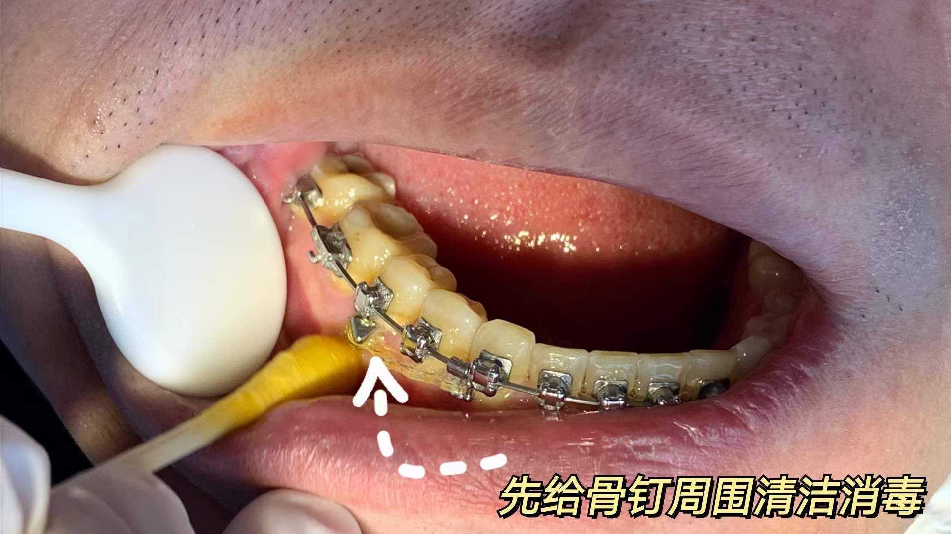 很多矫正顾客会担心拔出骨钉是否会留下孔洞的问题