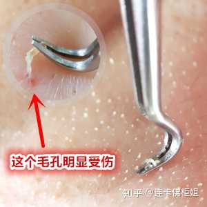 如何去除鼻子上的白色脂肪粒 知乎 如何去除鼻子上的白色脂肪粒 知乎