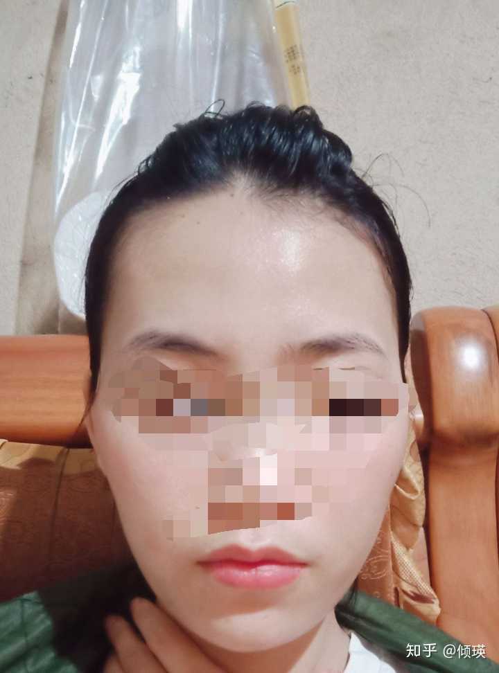 左右脸不对称 知乎