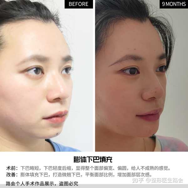 膨体丰下巴